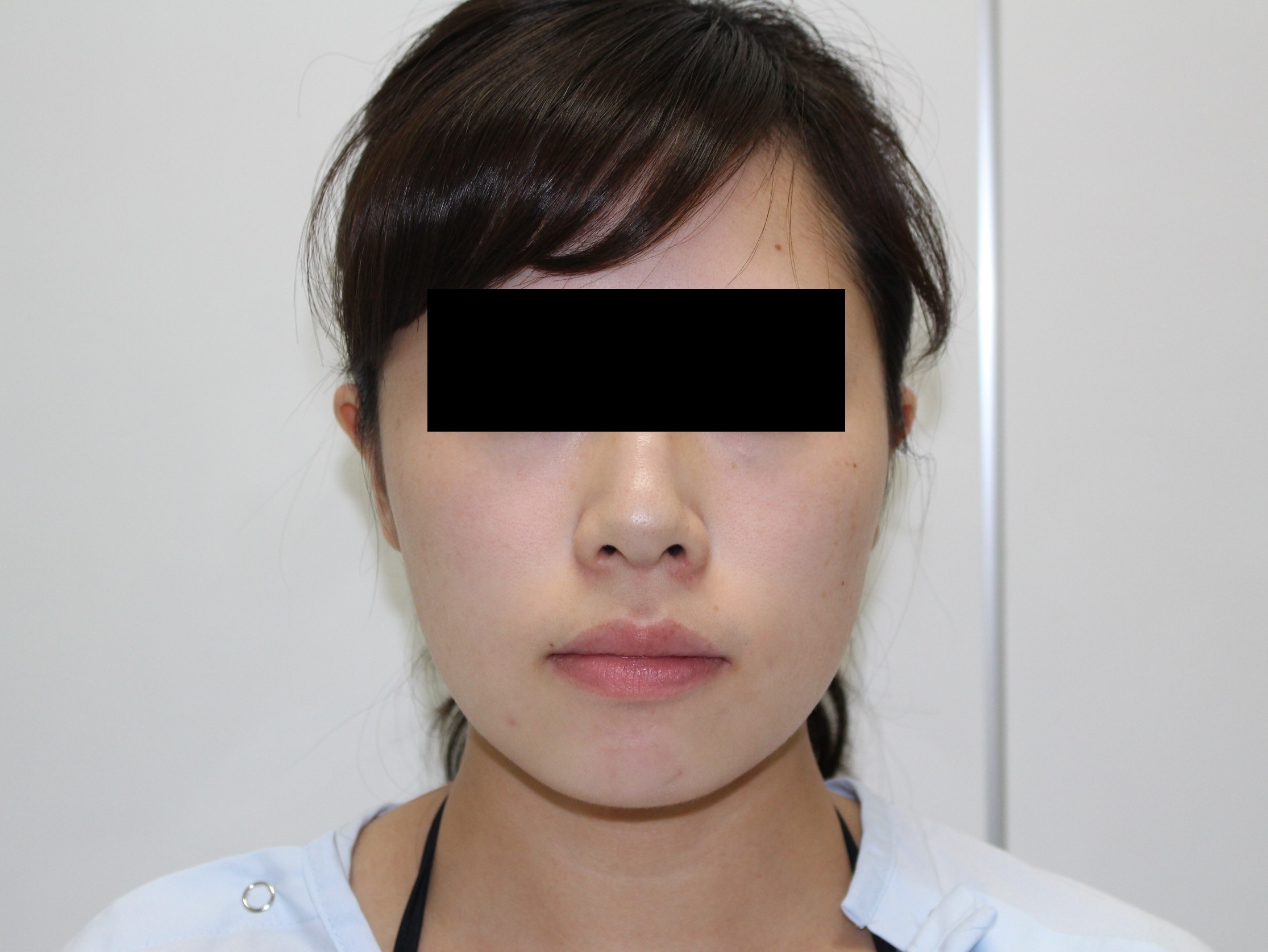 ★103　25歳女性　頬・あご下ベイザー脂肪吸引