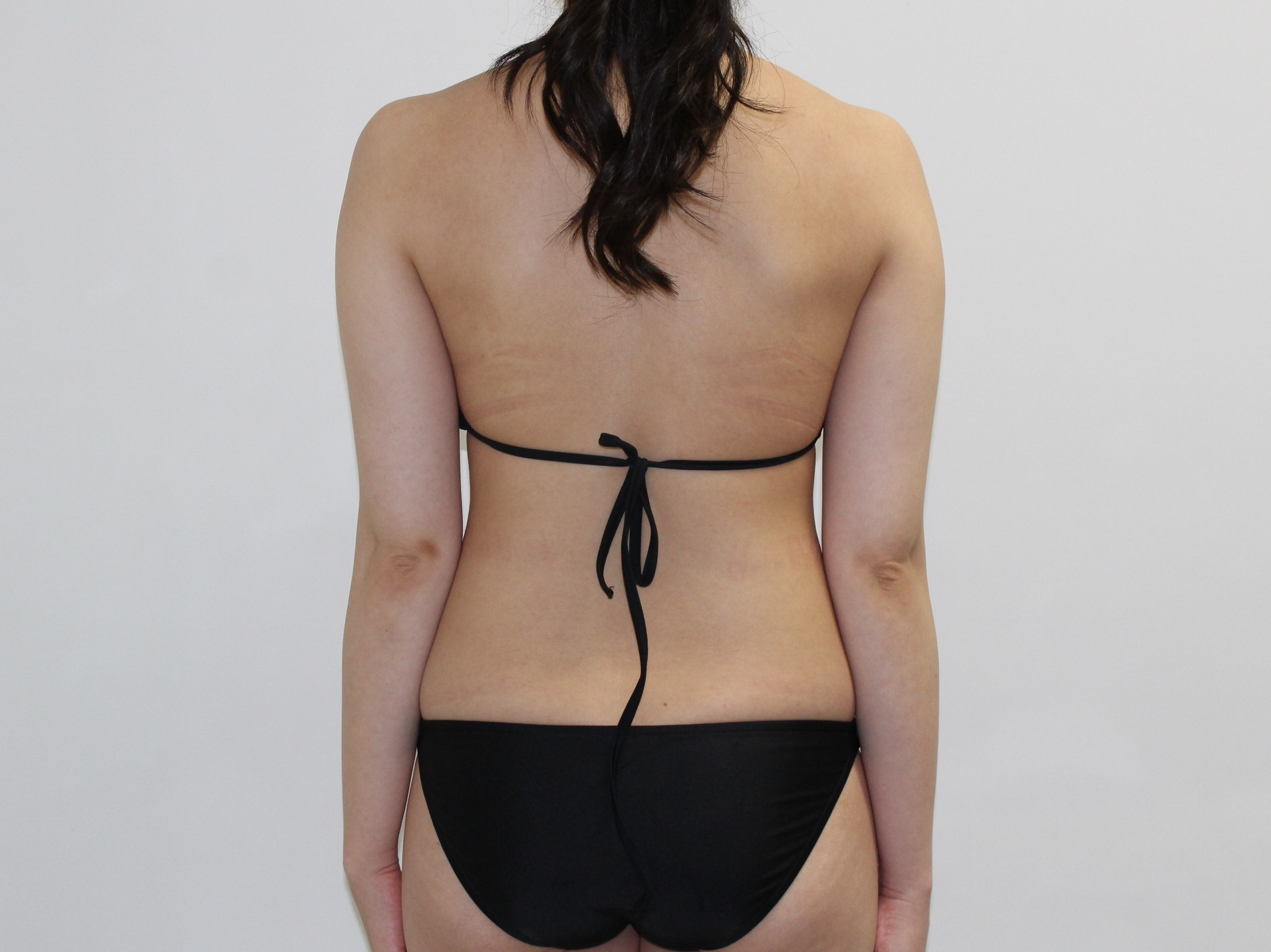 25歳女性　上腕（二の腕）+ワキ後ろ～肩甲骨上　VASER脂肪吸引　　半年まで