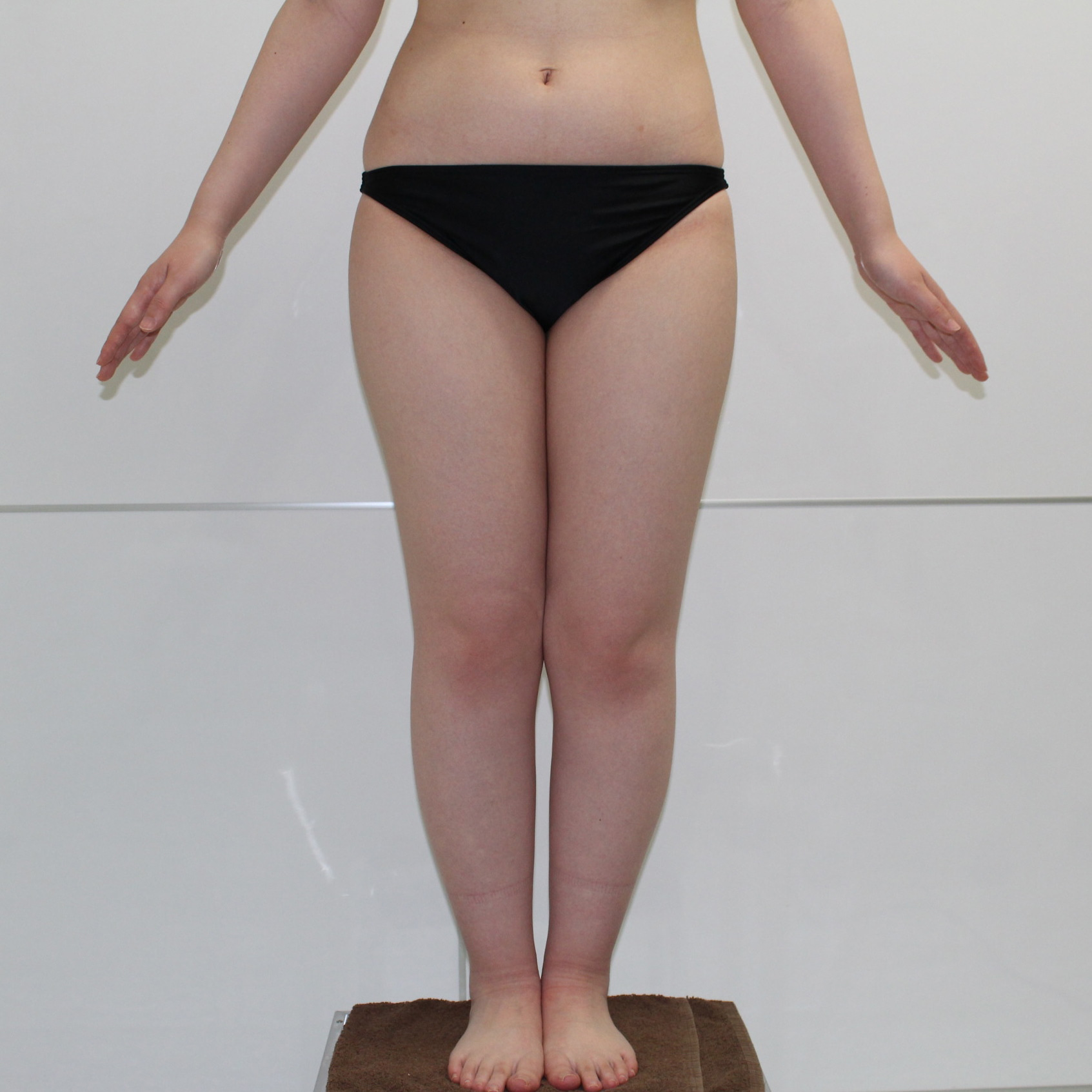 ★93　19歳女性　　安全のため一回で吸いきれない脂肪は右・左に分けて2