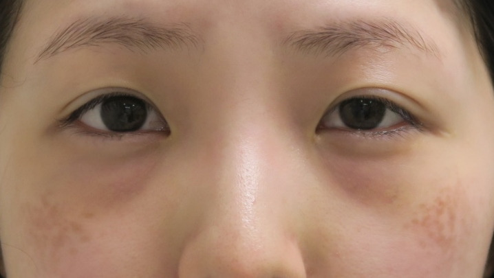 ★89　経結膜脱脂術+眼窩脂肪注入　+目頭切開で美しい目元へ　3