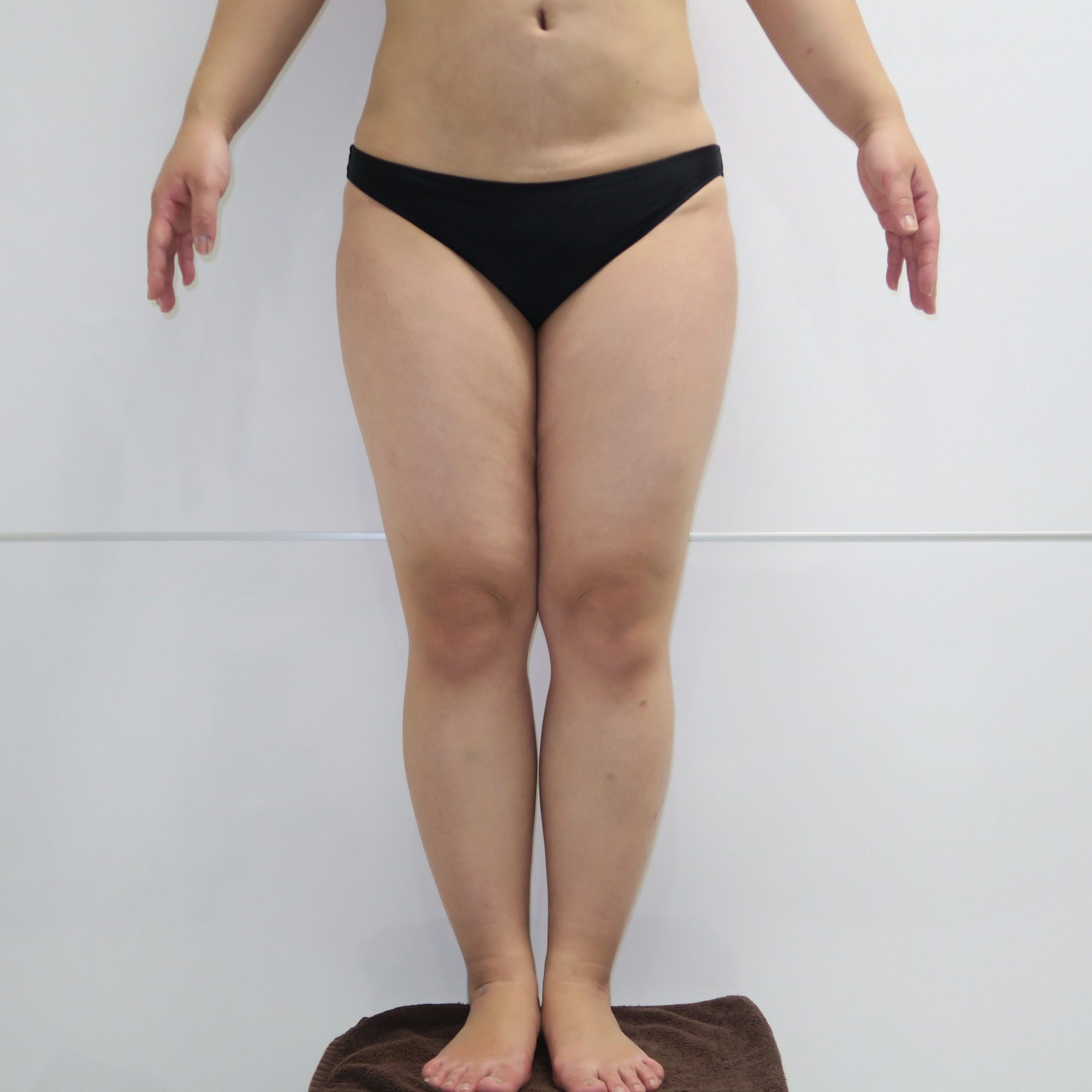 ★83-2【片脚ずつ吸引】35歳女性　163cm67kg　大腿臀部膝周りベイザー脂肪吸引