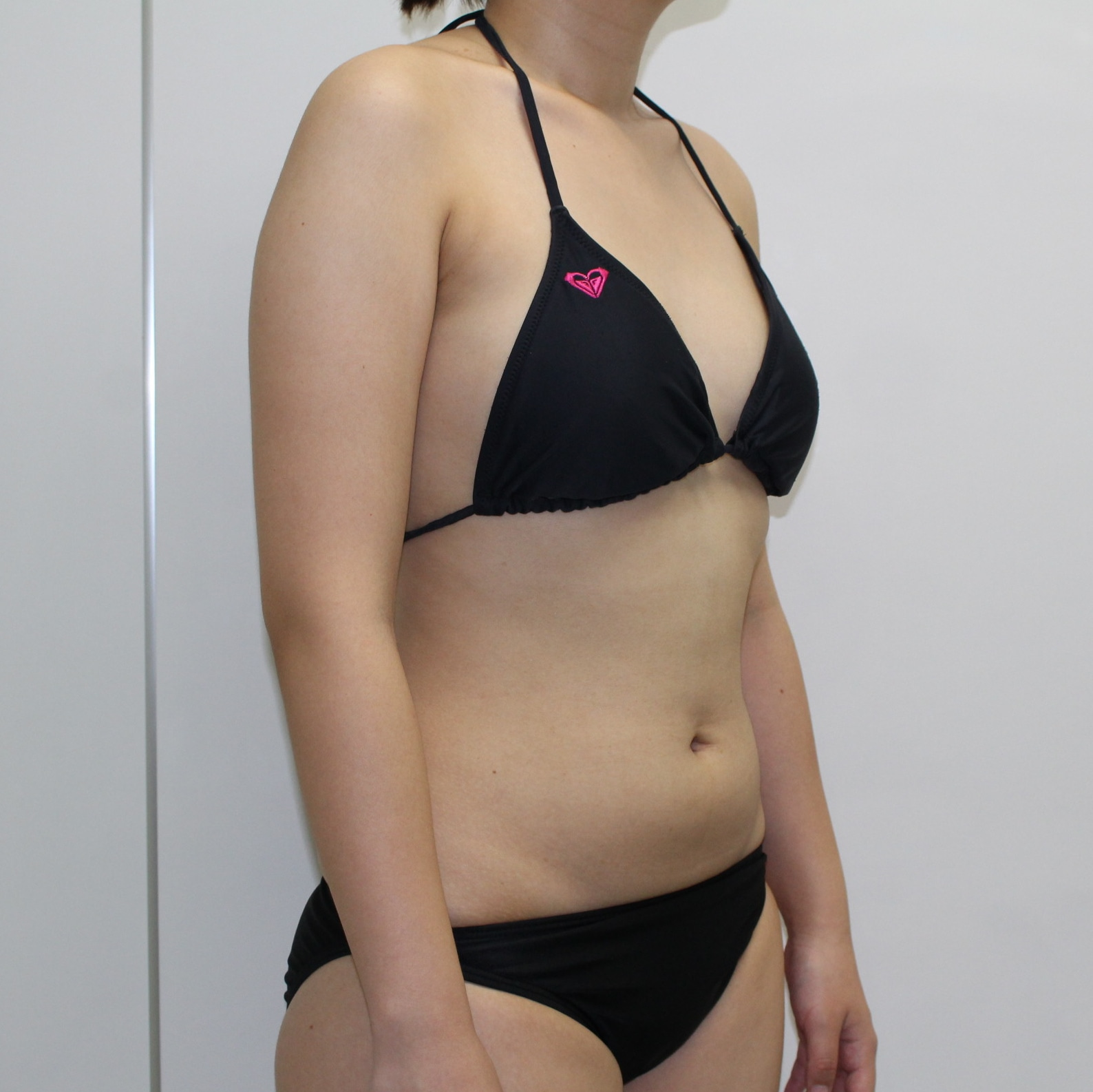 ●53　23歳女性　上腕脇後ろ～肩甲骨上VASER脂肪吸引