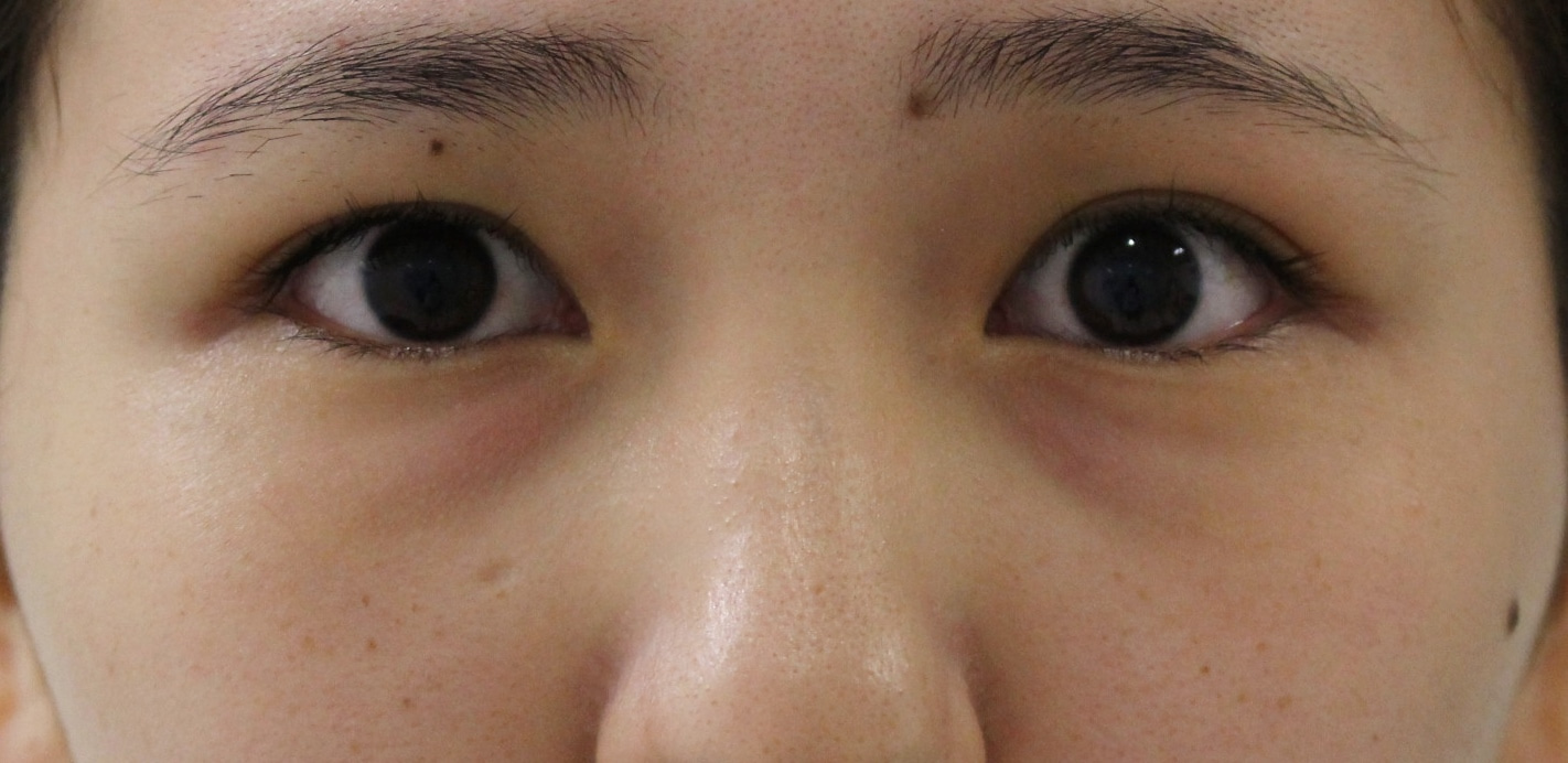 ★141　23歳女性　目の下のクマ　経結膜脱脂術+眼窩脂肪注入　立体感のある目元へ