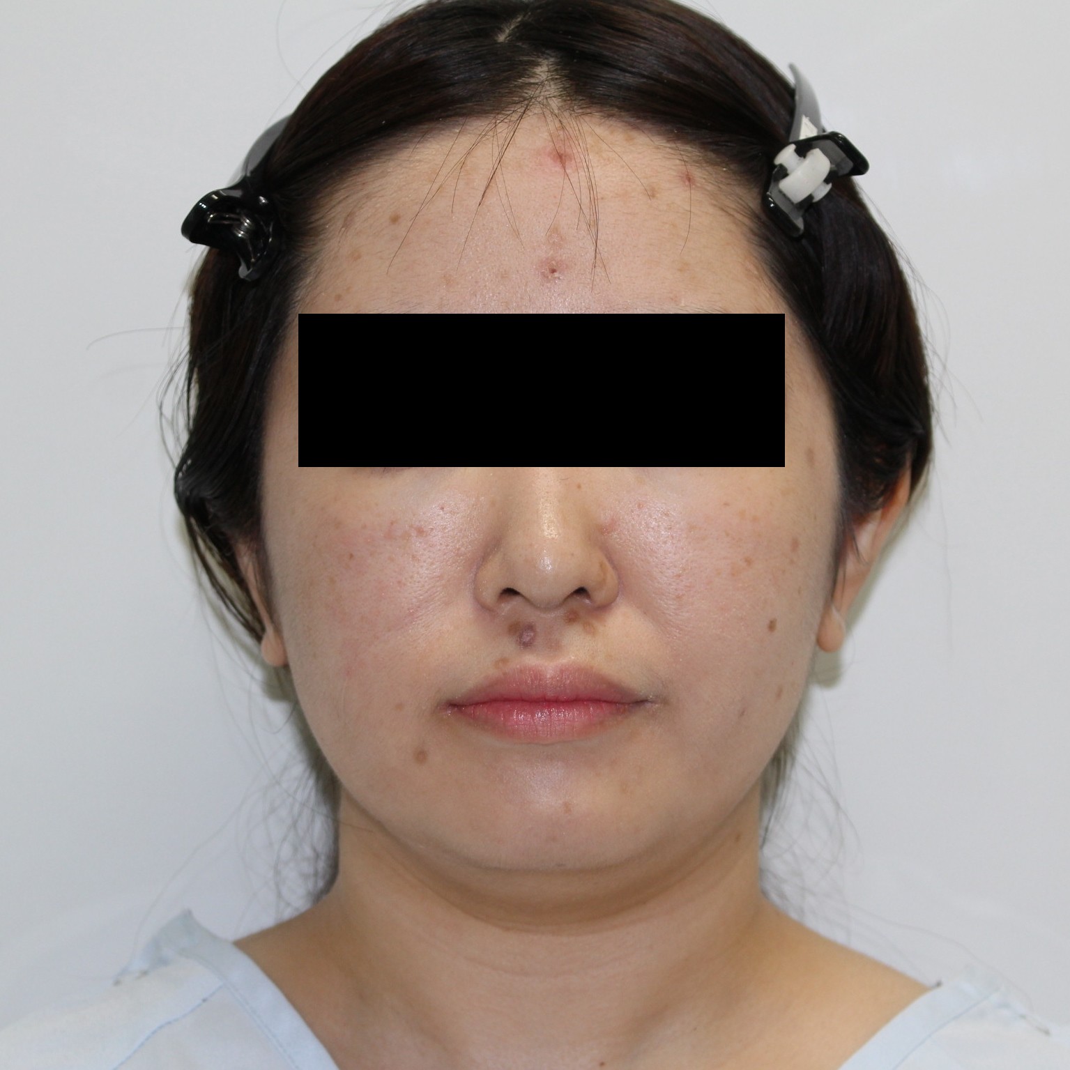 【別人級】★113　34歳女性　頬アゴ下ベイザー脂肪吸引　二重あご完全消失