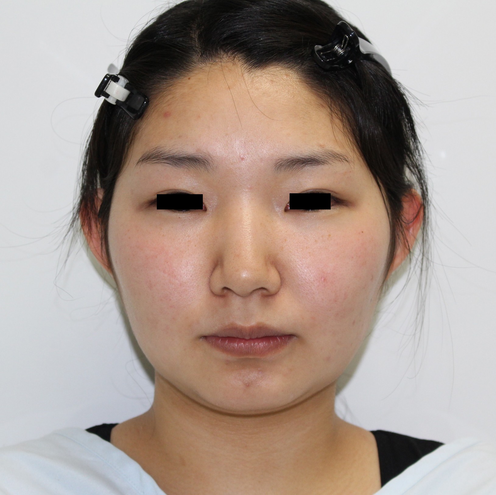 ★115　1ヶ月で途中経過　　20歳頬・アゴ下ベイザー脂肪吸引　