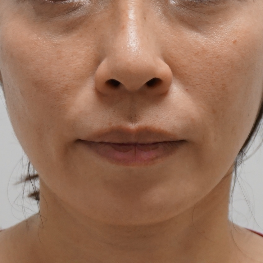 43歳女性　ジュビダームXCウルトラ　2ccでほうれい線と頬のコケ感改善