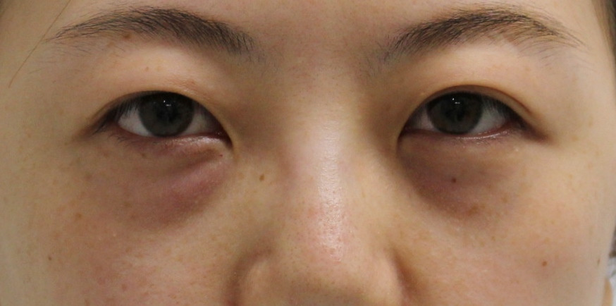 ★144　23歳女性 遠方からご来院　くま治療の患者様　経結膜脱脂術+眼窩脂肪注入