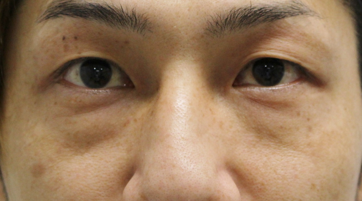 ★148　37歳男性　男だってくま改善で男前大幅アップ　経結膜脱脂術+眼窩脂肪注入