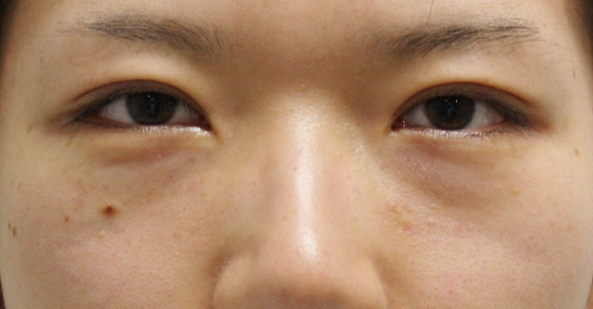 ★150　22歳女性　経結膜脱脂術+眼窩脂肪注入