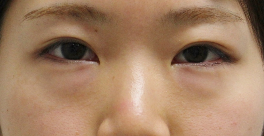 ★151　21歳女性　中学生から困っていた目の下のクマの治療