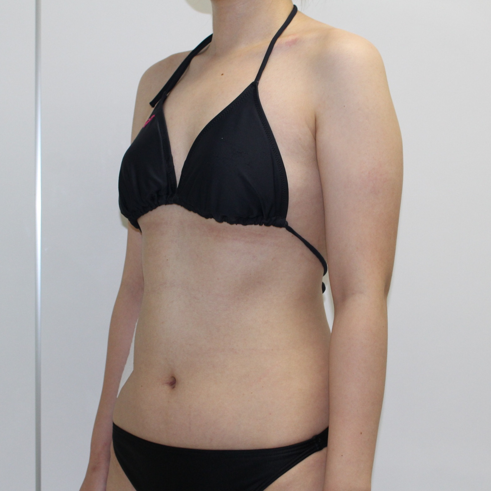 ●58　25歳女性 大腿臀部膝周り・上腕脇後ろ肩甲骨上VASER+CRFバスト 半年まで