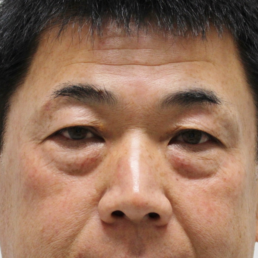 【劇的変化】☆13　★156　52歳男性　経結膜脱脂術+マイクロCRF（目の下・中顔面）眉下切開