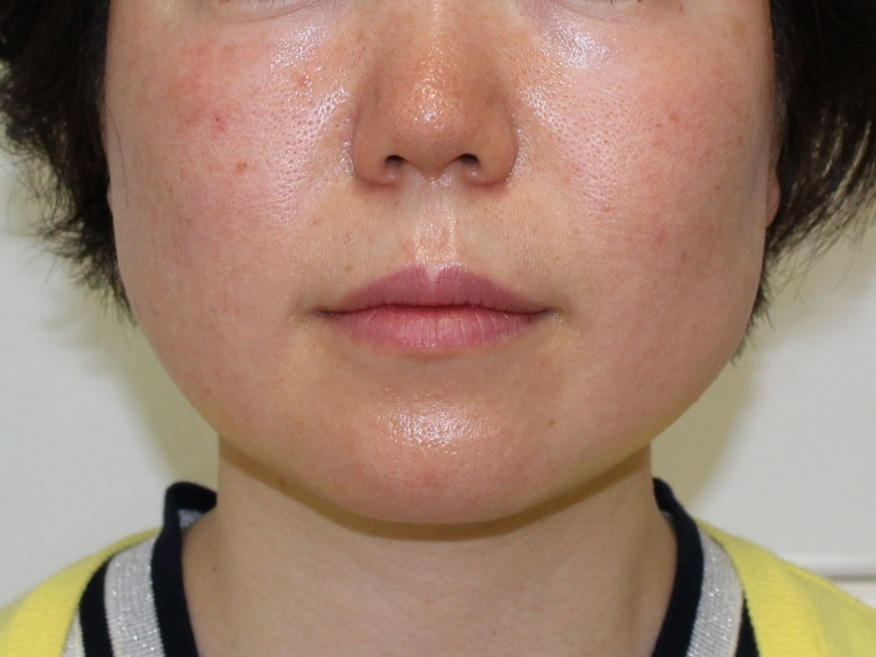 【著効】36歳女性　エラのボトックスビスタ（100ユニット）　△な顔型→▽顔型