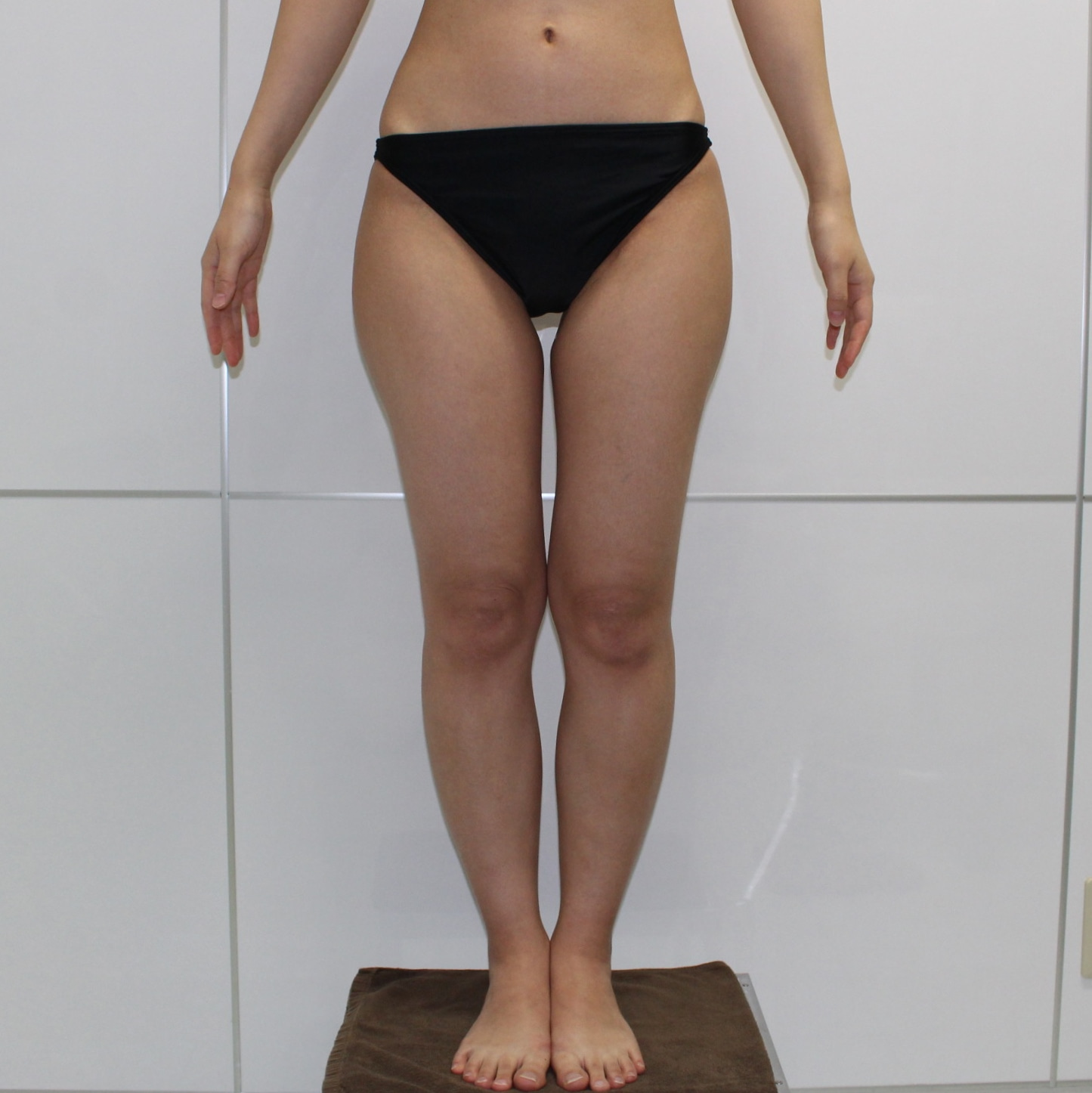 【劇的変化】★97　33歳女性　大腿臀部膝周りVASER+CRFバスト　