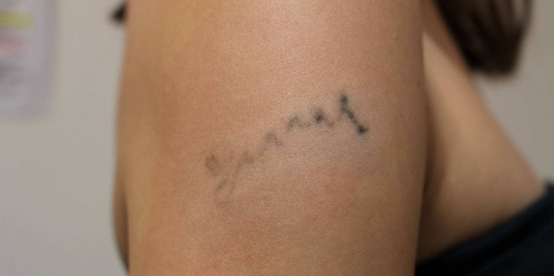 自分で彫った腕のTattoo　レーザーで除去
