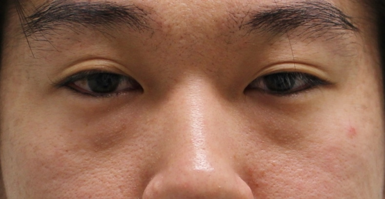 ★167　30歳男性　男もクマ改善で男前アップ！！　経結膜脱脂術+脂肪注入（ベイザー脂肪）
