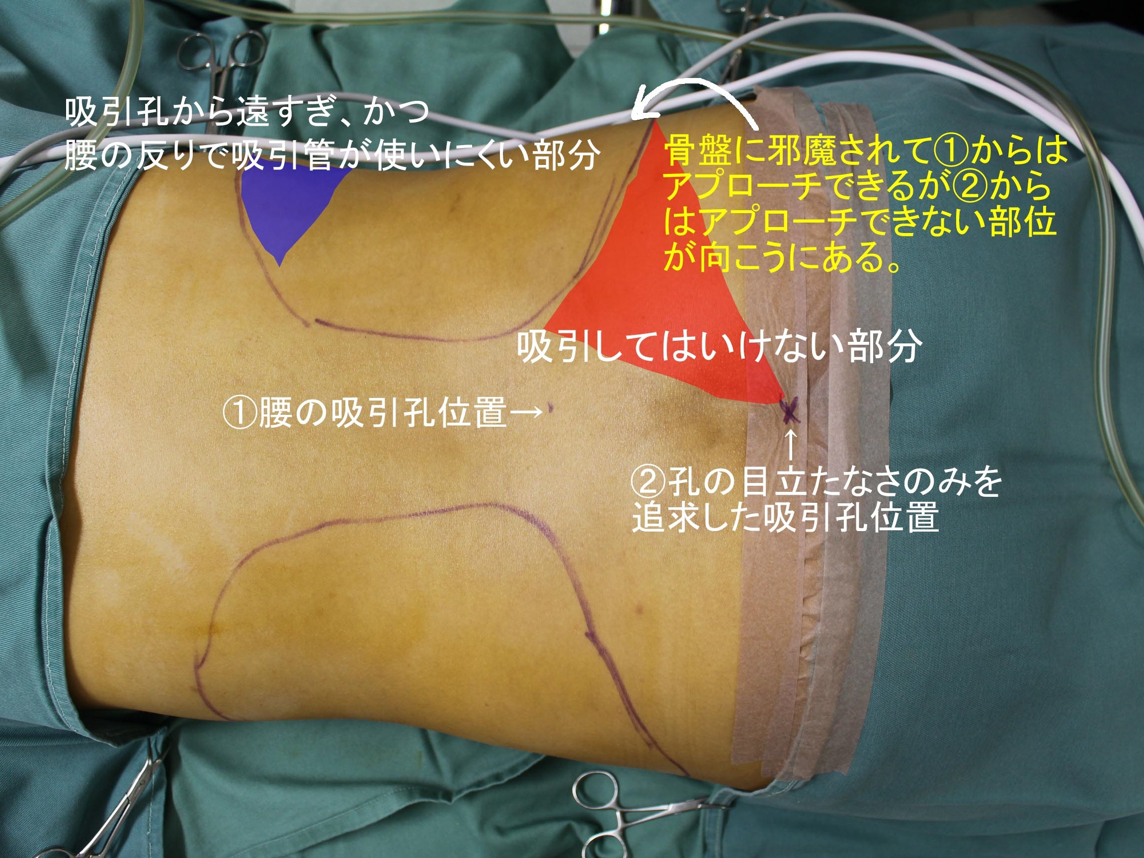 僕が腰の脂肪吸引孔をお尻の割れ目の部位にしない3つの理由