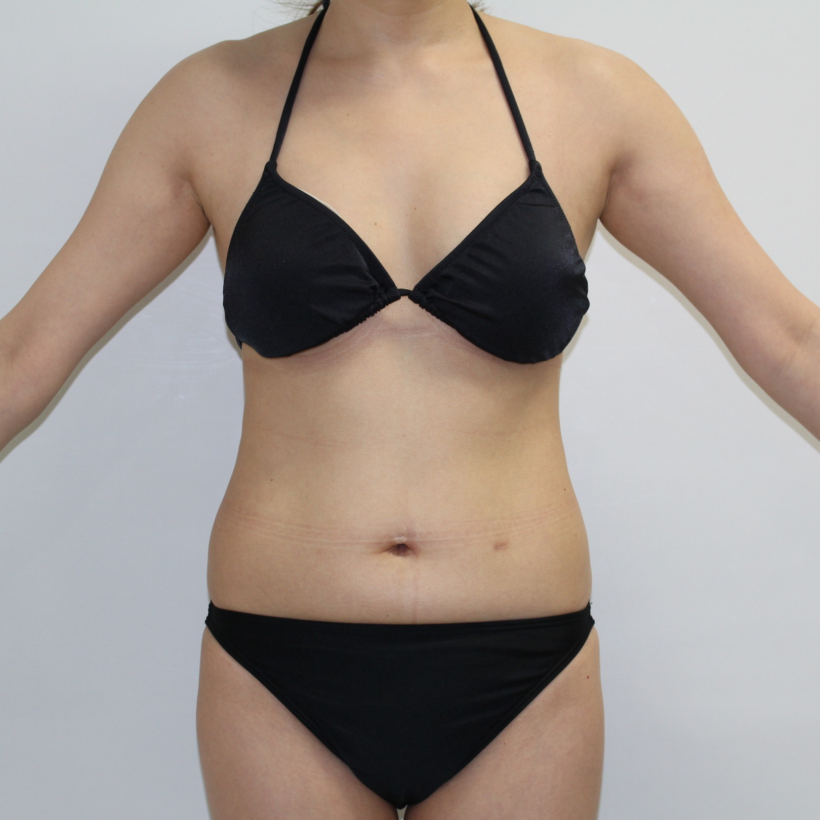 腹★73　40歳女性　腹腰ベイザー脂肪吸引（その後他院にてバストバッグインプラント(;^ω^A）