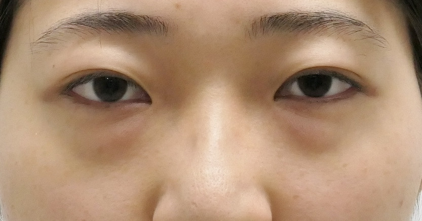 ★174　22歳女性　経結膜脱脂術+眼窩脂肪注入