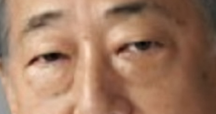 ハムラ法・裏ハムラ法（脂肪再配置）が”確実に再発”する理由　2　※目の下の眼窩脂肪は”増える”