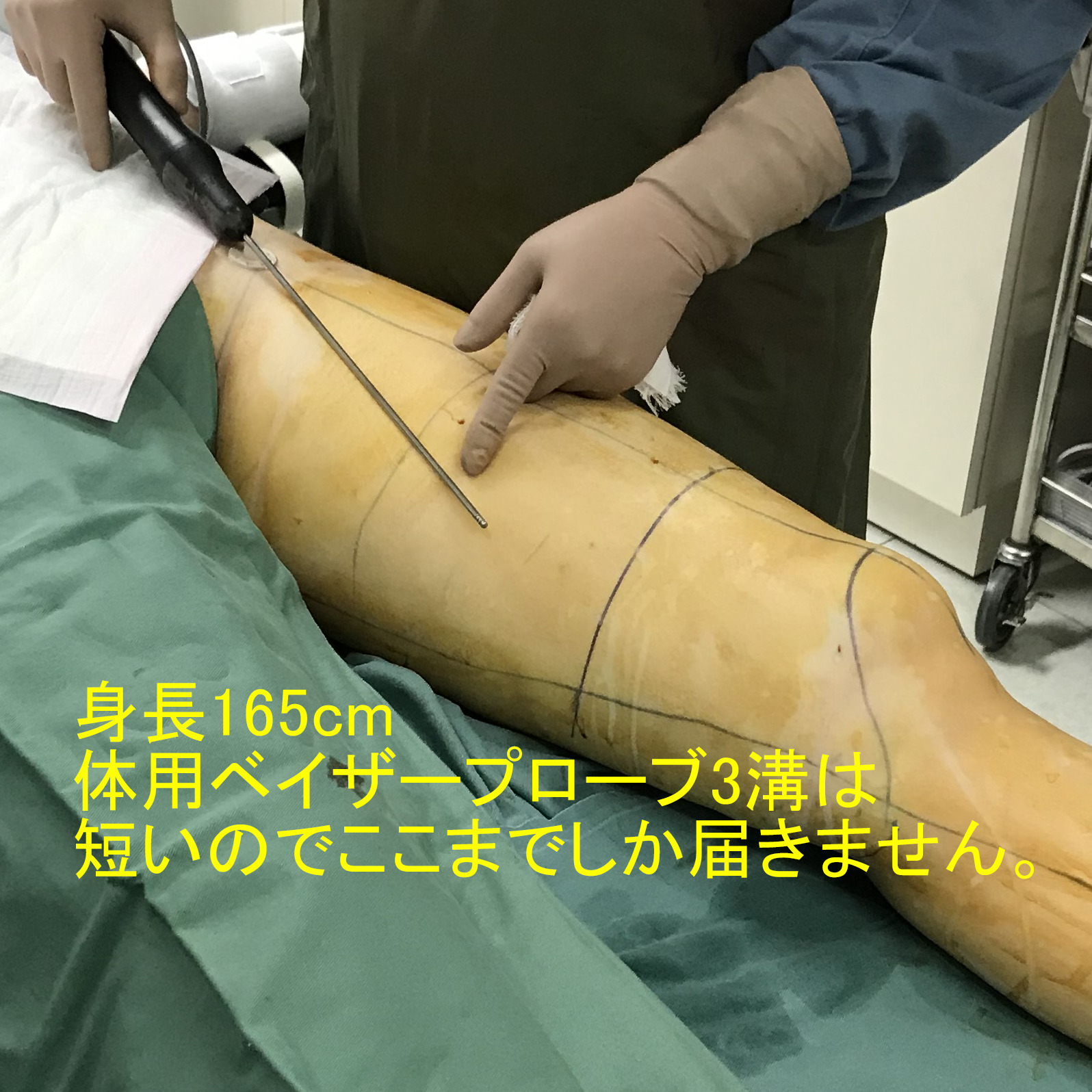 ベイザーはそけい部から膝に届きません(｀・ω・´)