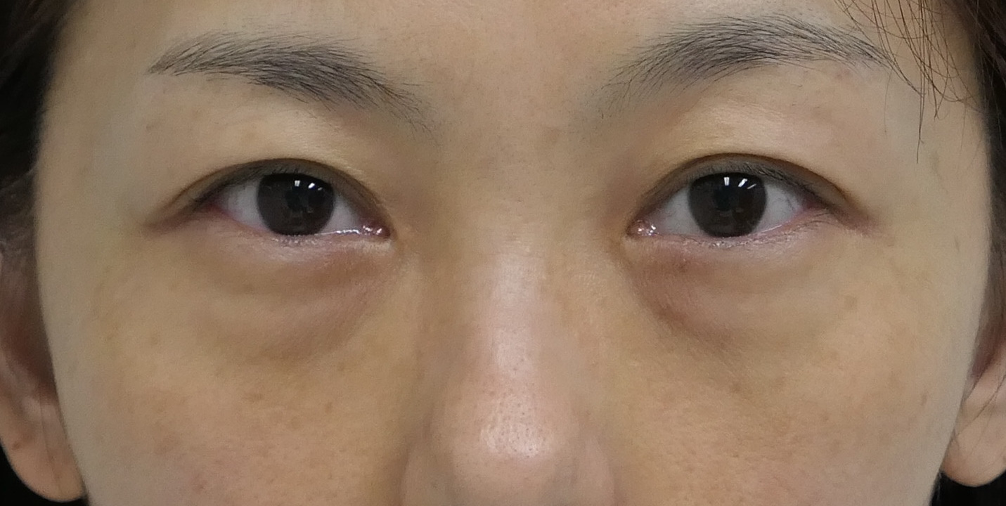 ★180　48歳女性　経結膜脱脂術+眼窩脂肪注入