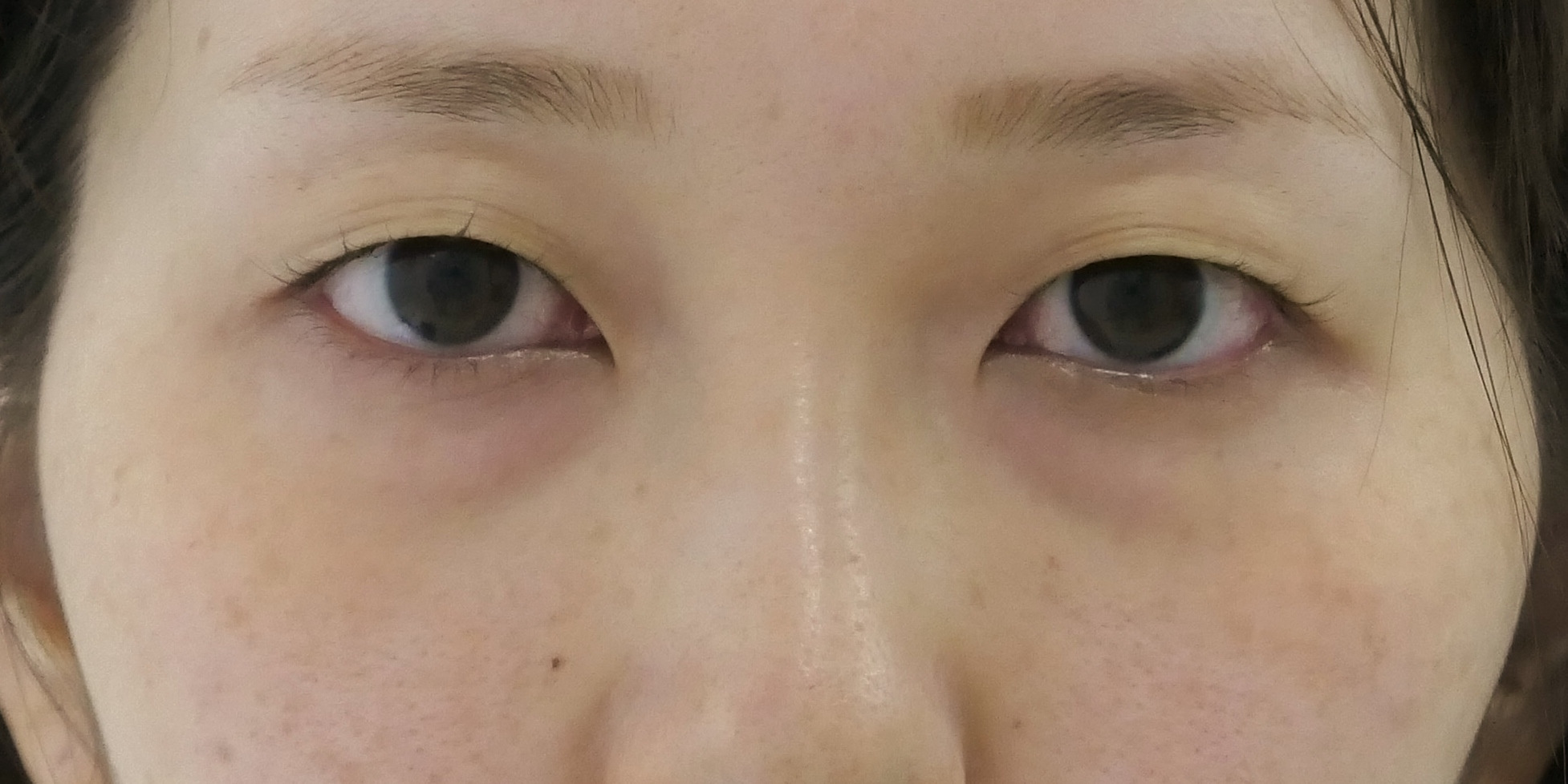 ★182　29歳女性　経結膜脱脂術+眼窩脂肪注入+プレミアムクイック