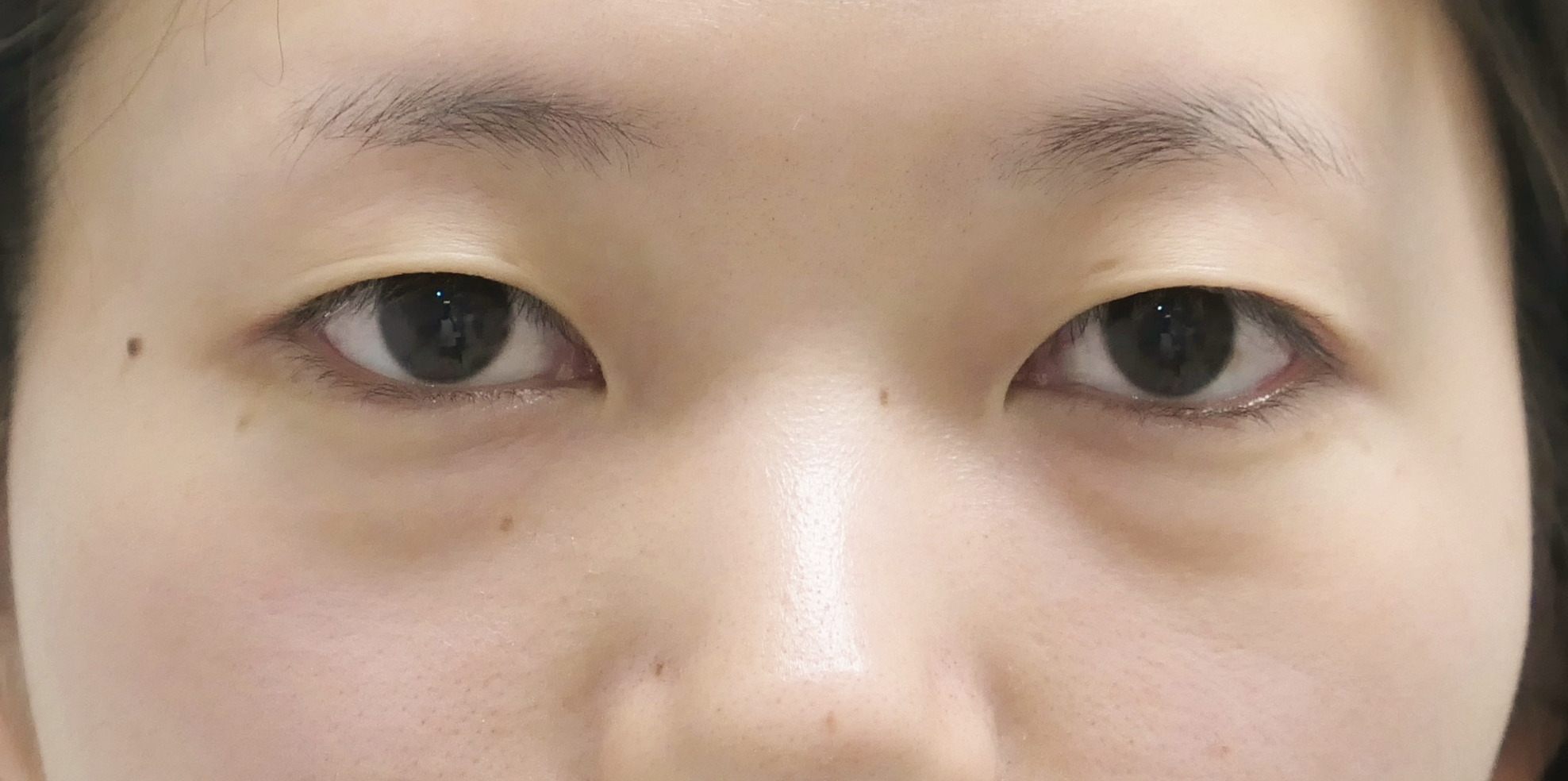 ★183　25歳女性 経結膜脱脂術+眼窩脂肪注入+プレミアムクイック