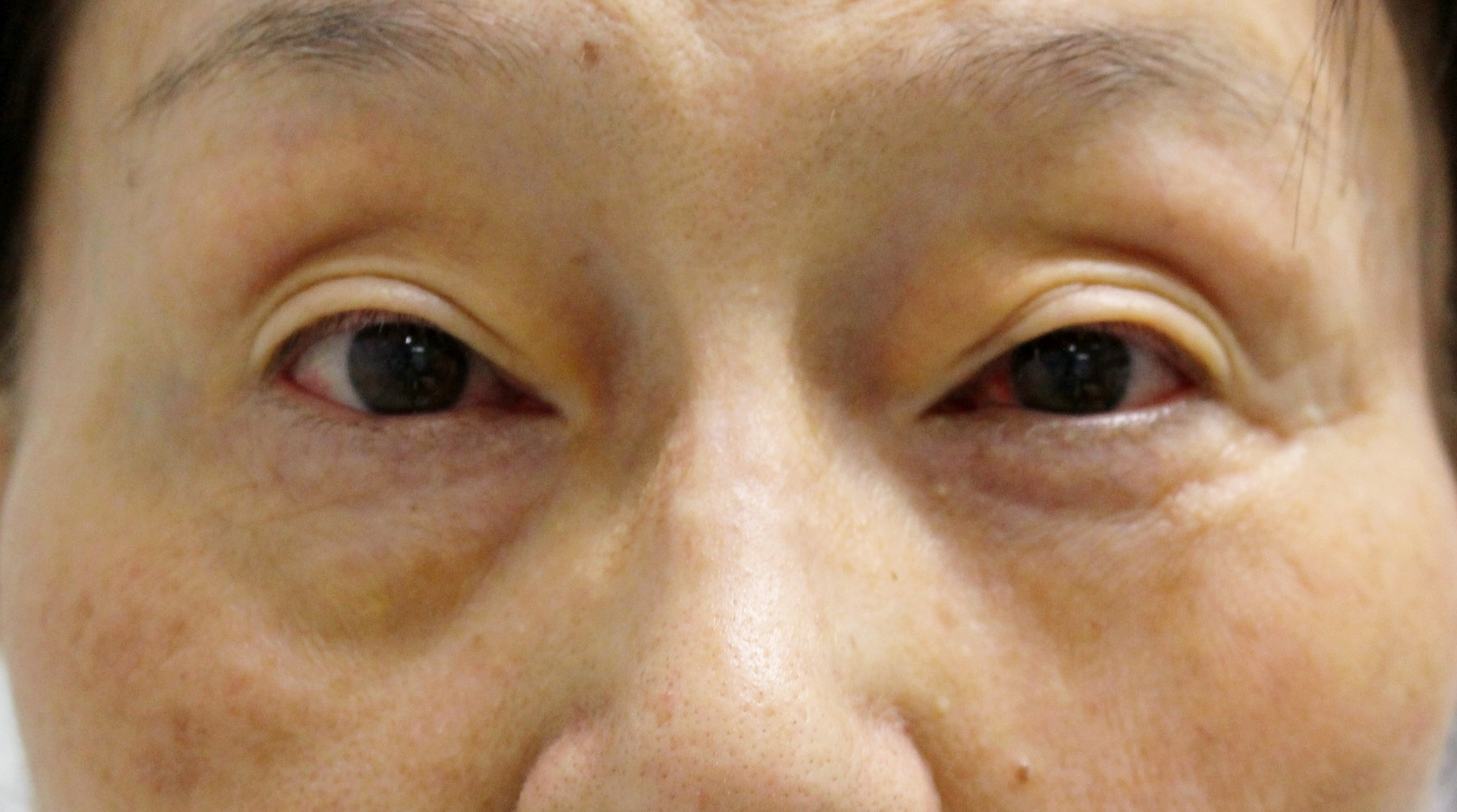 73歳女性　　目の下切開を伴うたるみ取り+目の下・中顔面脂肪注入