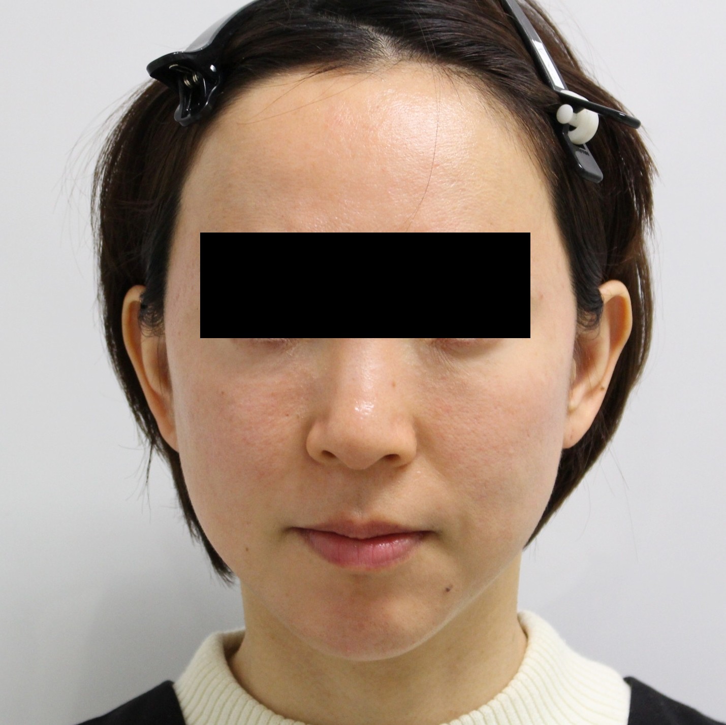45歳女性　中顔面ヒアルロン酸ボリフト【他院PRP+成長因子によるシコリ】