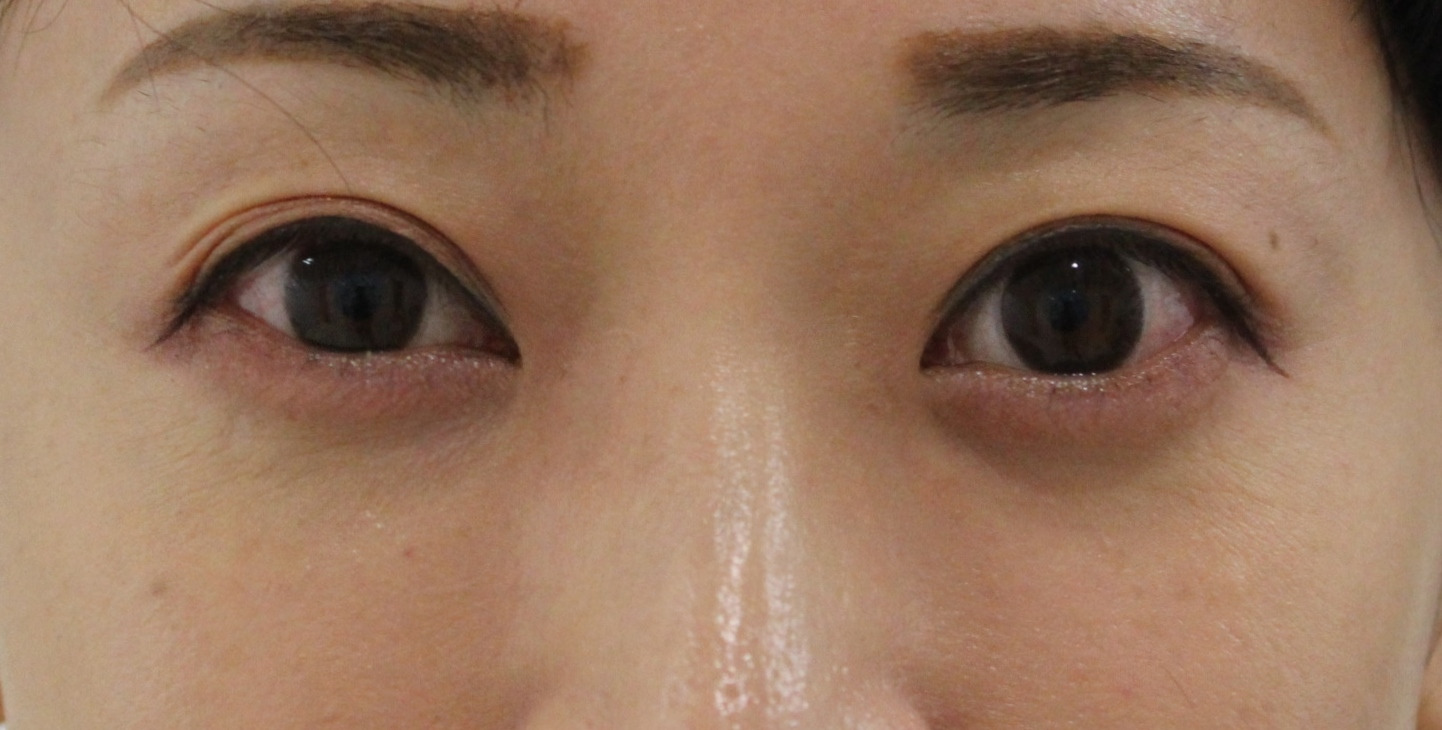 それってゴルゴ線？　　いえそれはゴルゴ線では無いので”コレ”で治療可能です！！