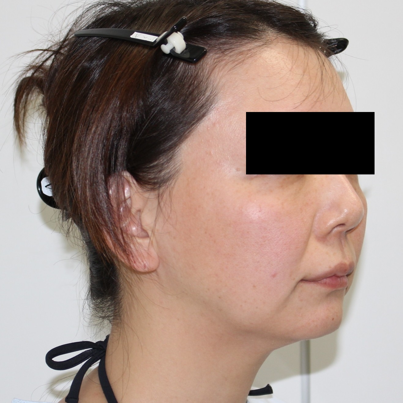 ★51　41歳女性　シグネチャーリフト+頬顎下ベイザー+脂肪注入