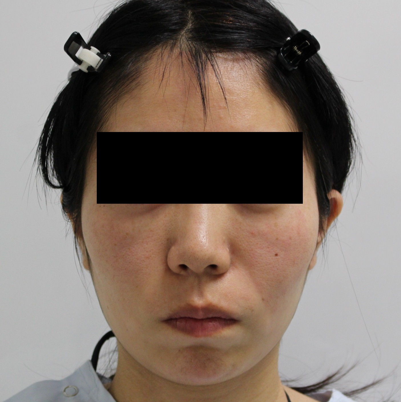【ゴルゴ線消失】27歳女性　ゴルゴ線剥離とマイクロCRF（中顔面・ほうれい線）