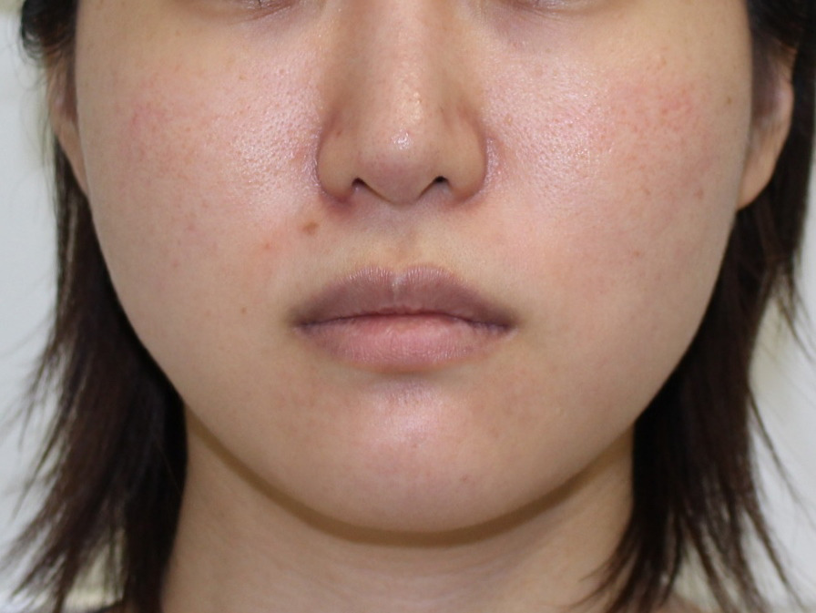 28歳女性　エラBOTOXビスタでわかりやすく小顔効果