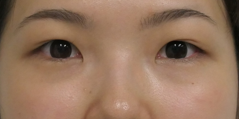 ★193　経結膜脱脂術+眼窩脂肪注入+セミプレミアムクイック・マイクロカット脂肪除去