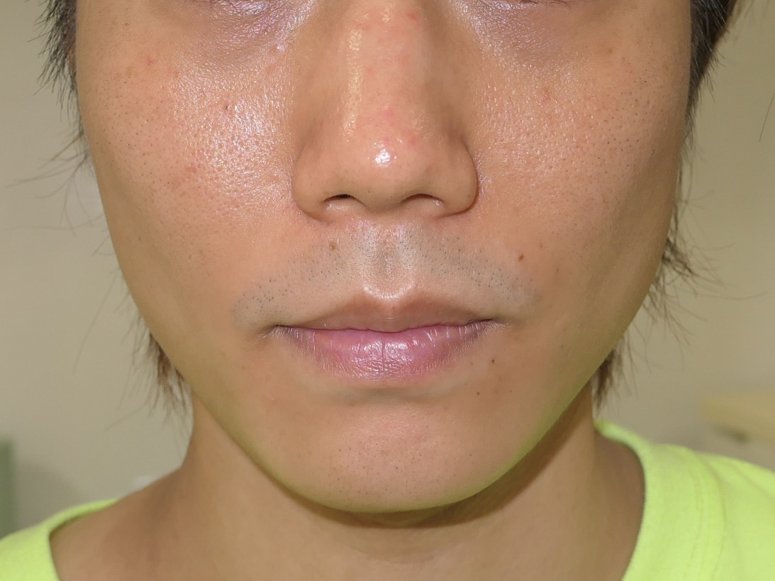 男性のエラボトックスビスタ（小顔注射）　こけた印象から優しげに