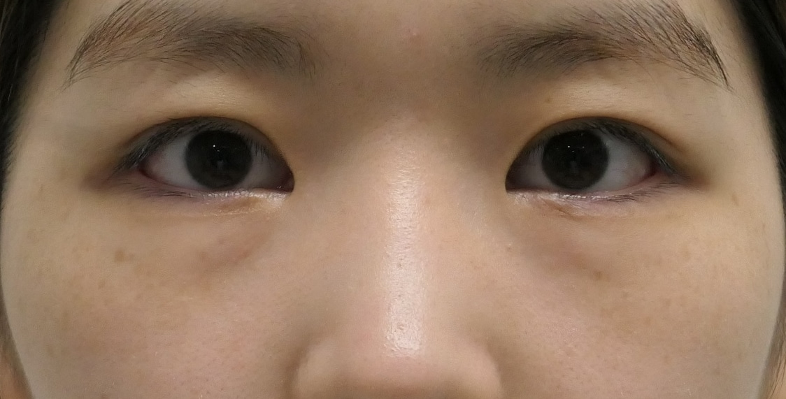★195　22歳女性　顔がキレイになるための経結膜脱脂術+眼窩脂肪注入