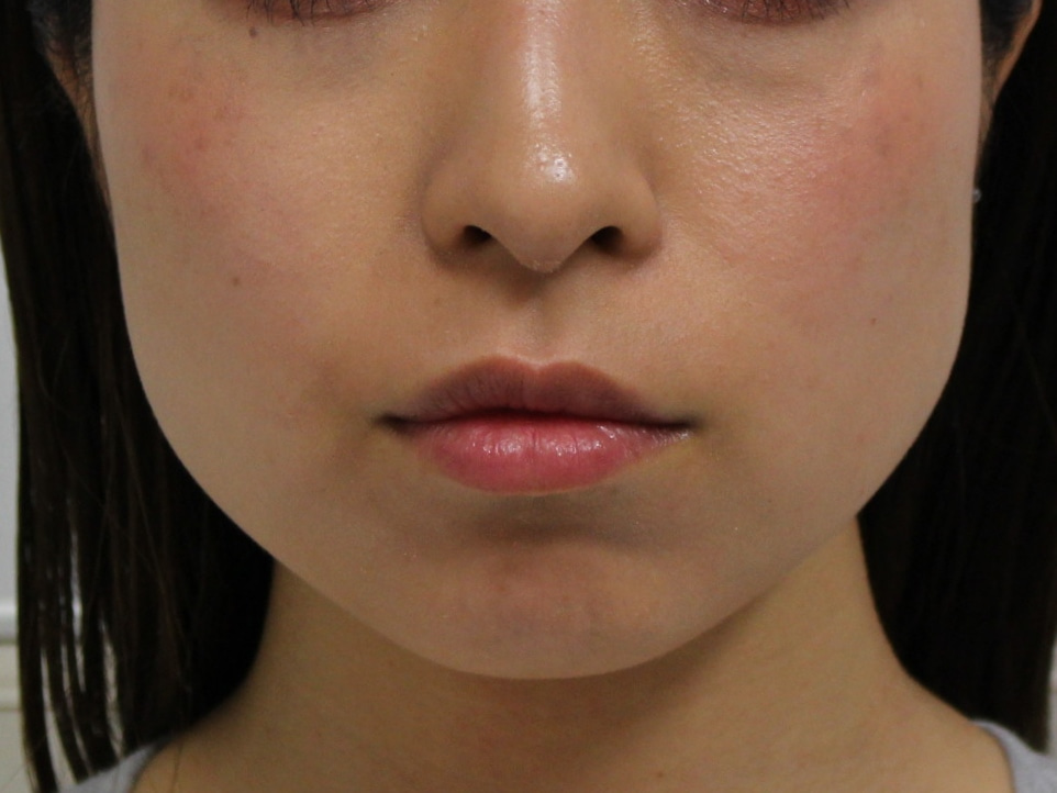 【著効】34歳女性　小顔ボトックス