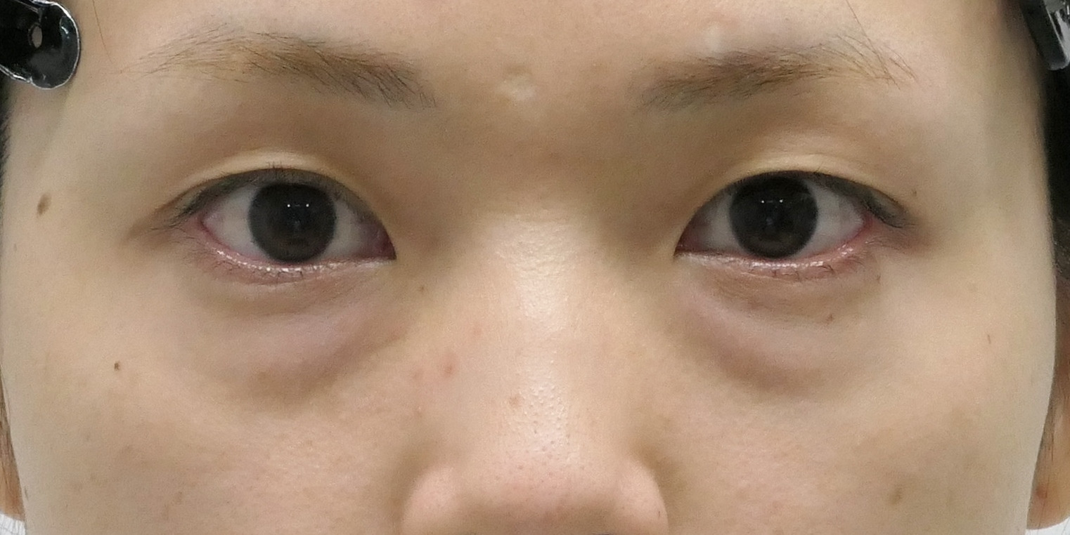★198　30歳女性　経結膜脱脂術+眼窩脂肪注入