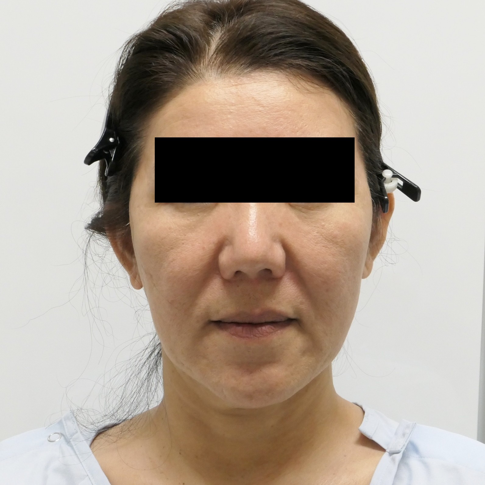 ★137【切らないフェイスリフト】49歳女性　頬顎下ベイザー・アキーセル+脂肪注入