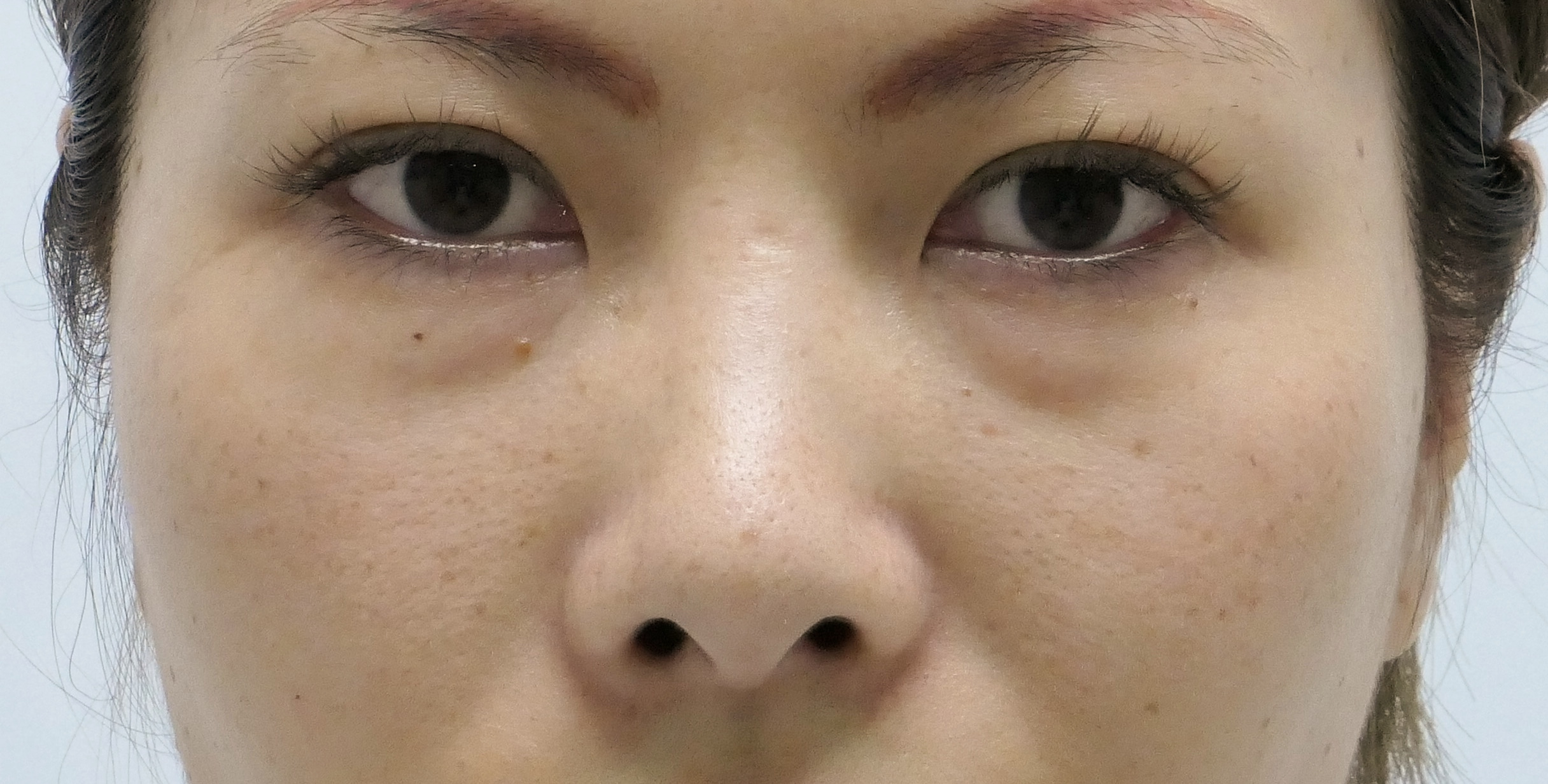 ★202　36歳女性　経結膜脱脂術+マイクロCRF　目の下・中顔面・ほうれい線