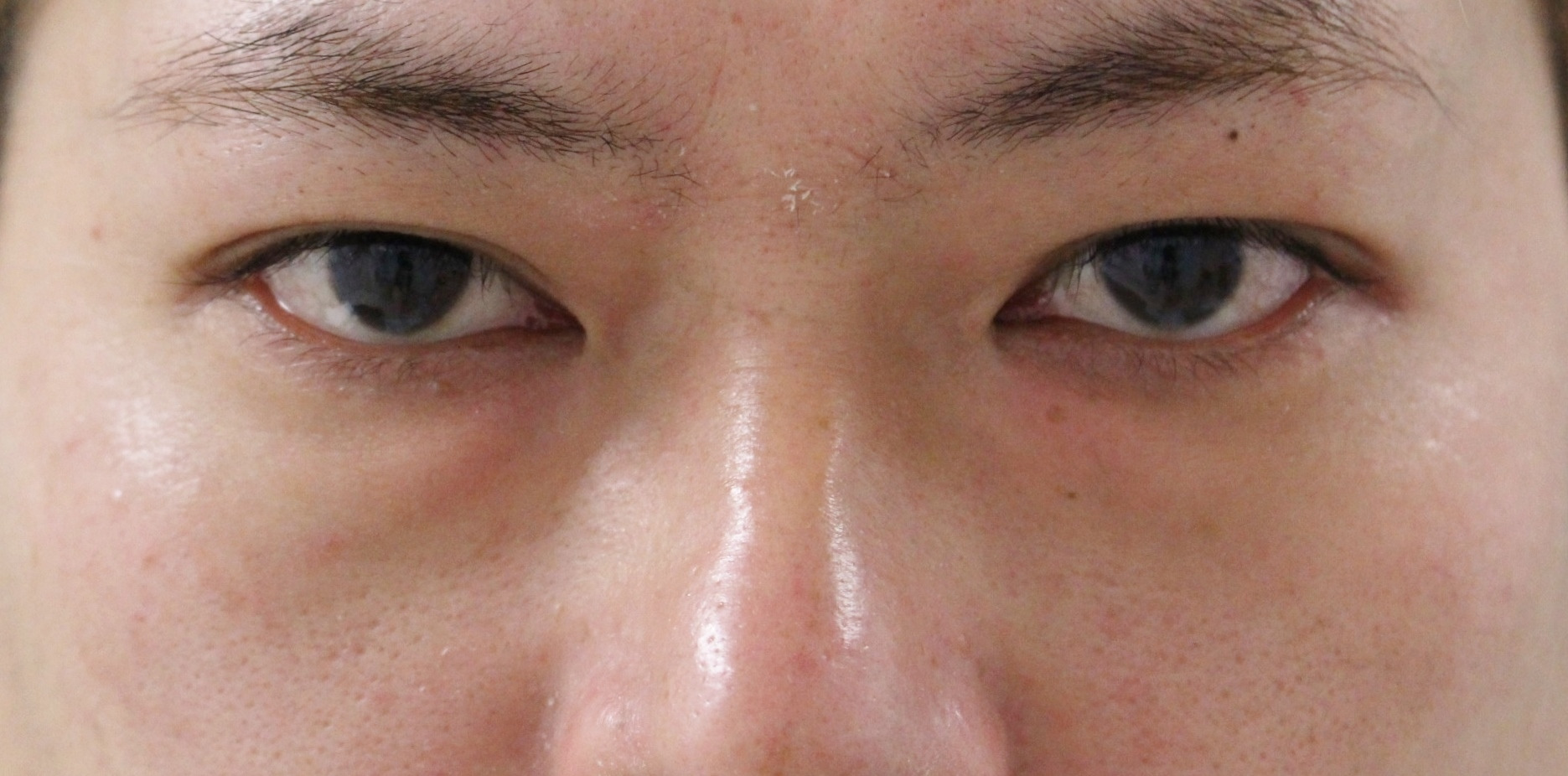 ★203　41歳男性　経結膜脱脂術+眼窩脂肪注入