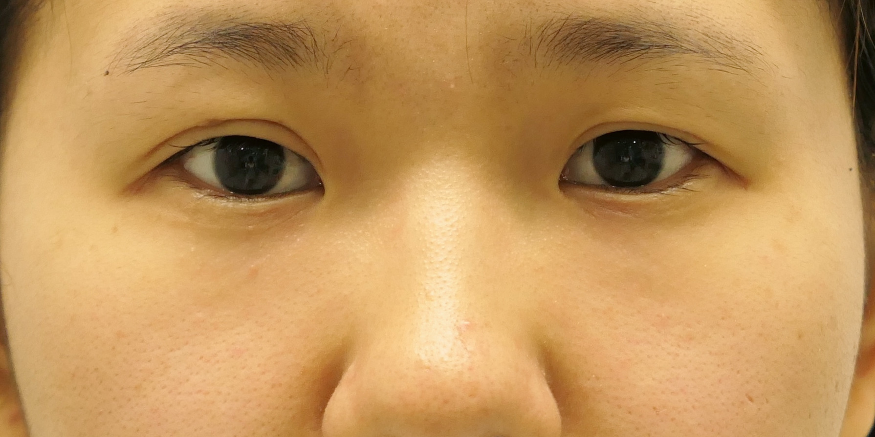 ★176　他院眼瞼下垂手術（切開法）修正+涙袋がでて可愛くなるための経結膜脱脂術2
