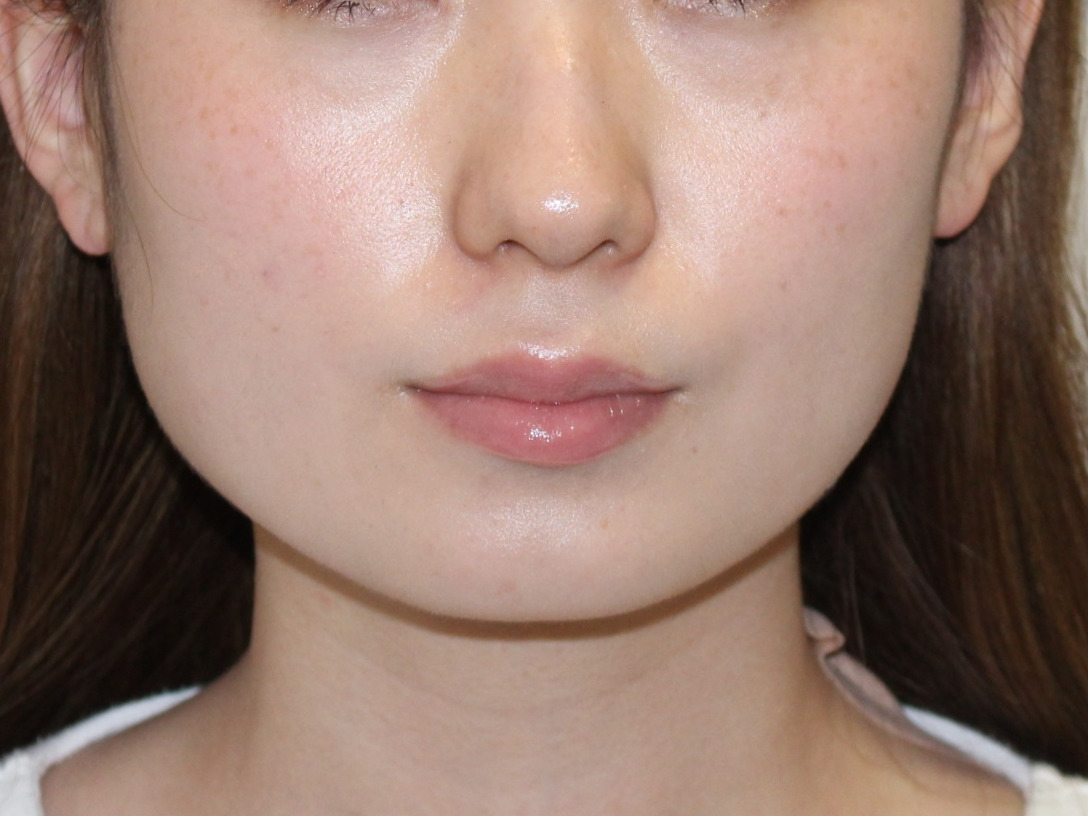 【今回も著効】28歳女性　エラボトックス　