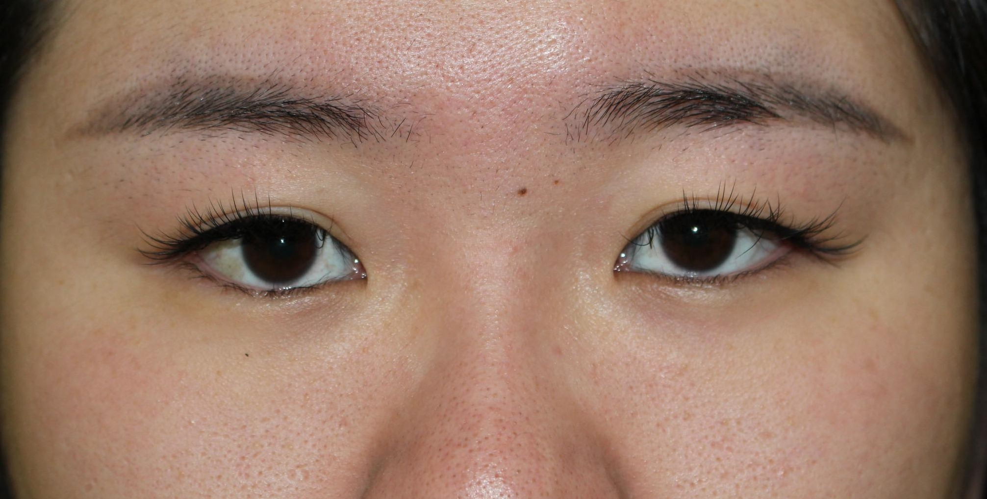 24歳女性　とても重い瞼　セミプレミアムクイック+マイクロカット脂肪除去