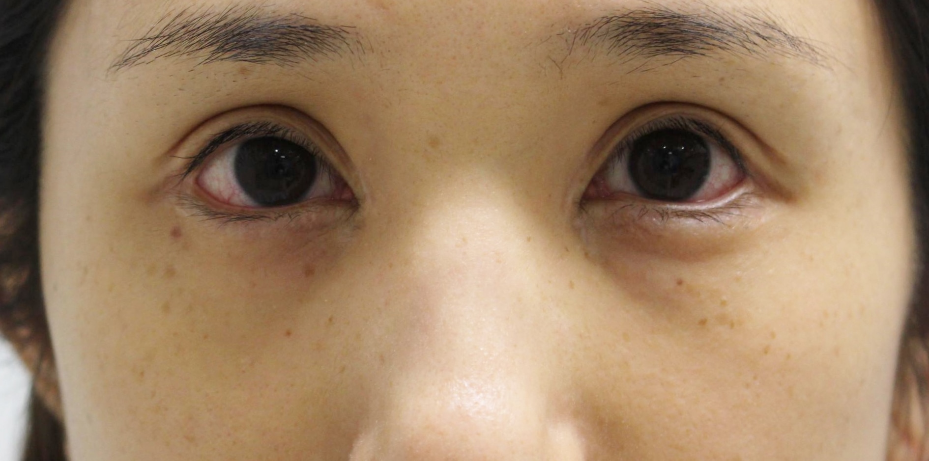 ★206　いろいろな目元手術後　経結膜脱脂術+眼窩脂肪注入