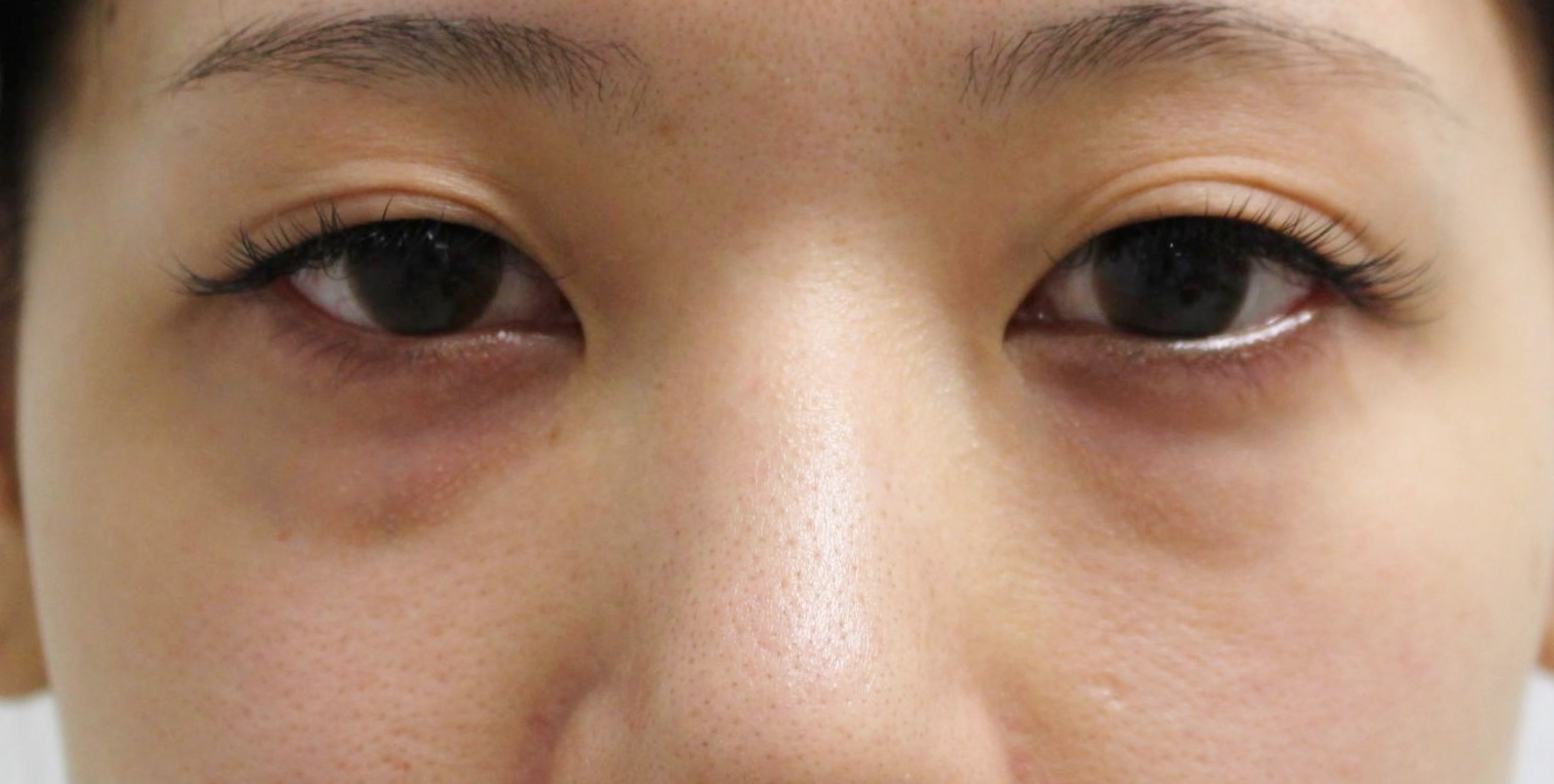 ★207　経結膜脱脂術+眼窩脂肪注入+プレミアムクイック　26歳女性