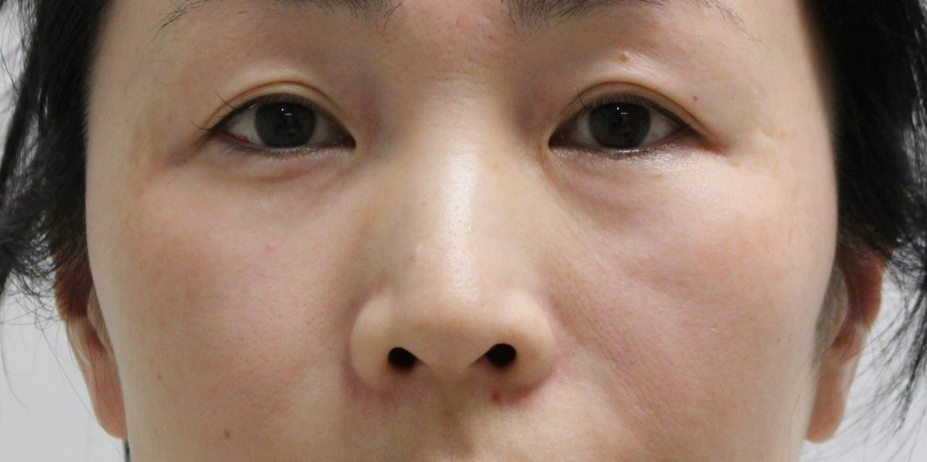 【術後1日目写真あり】★209　46歳女性　経結膜脱脂術+目の下中顔面VASER脂肪注入