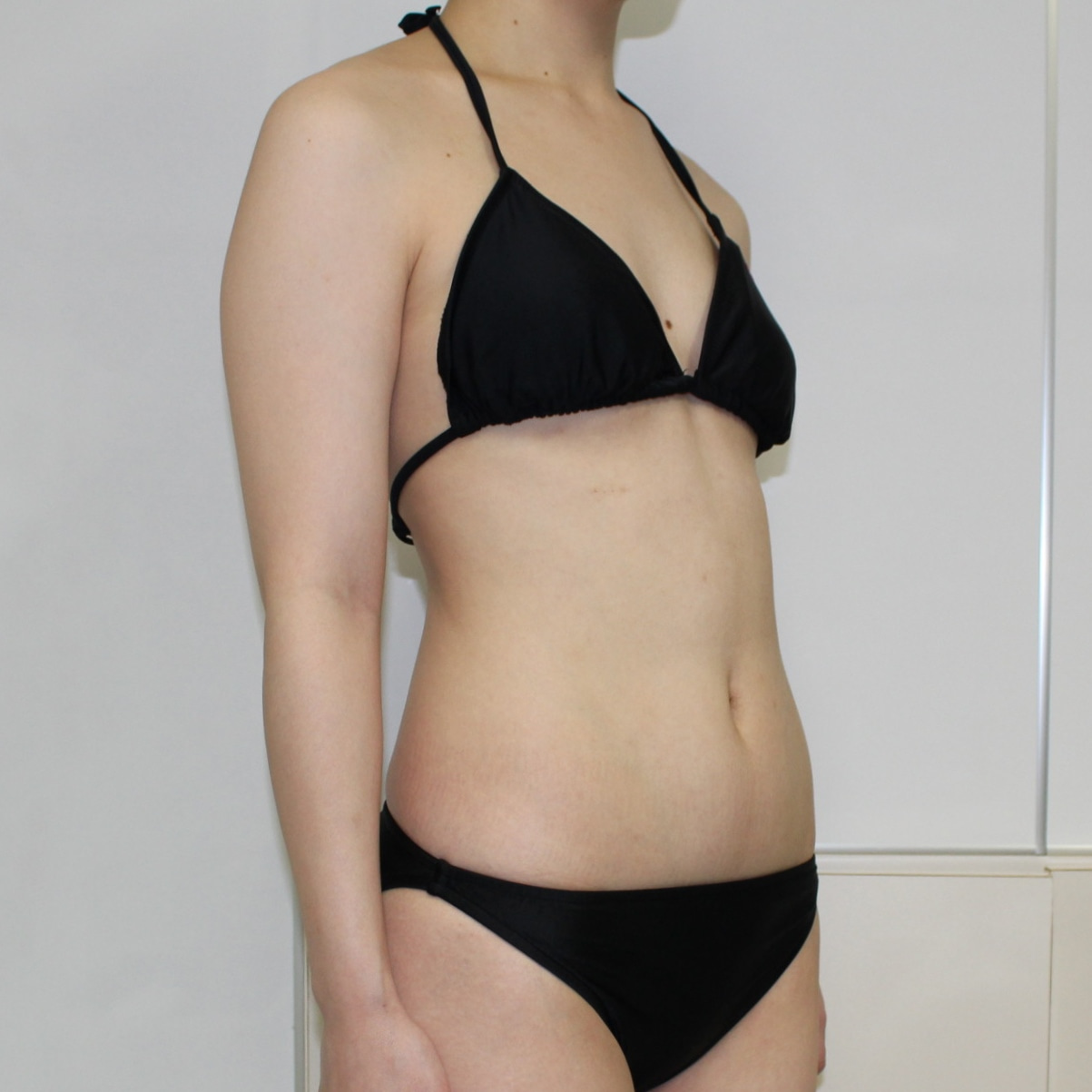 ●66　24歳女性　二の腕・肩～ワキ後ろ・肩甲骨上　VASERアキーセル脂肪吸引