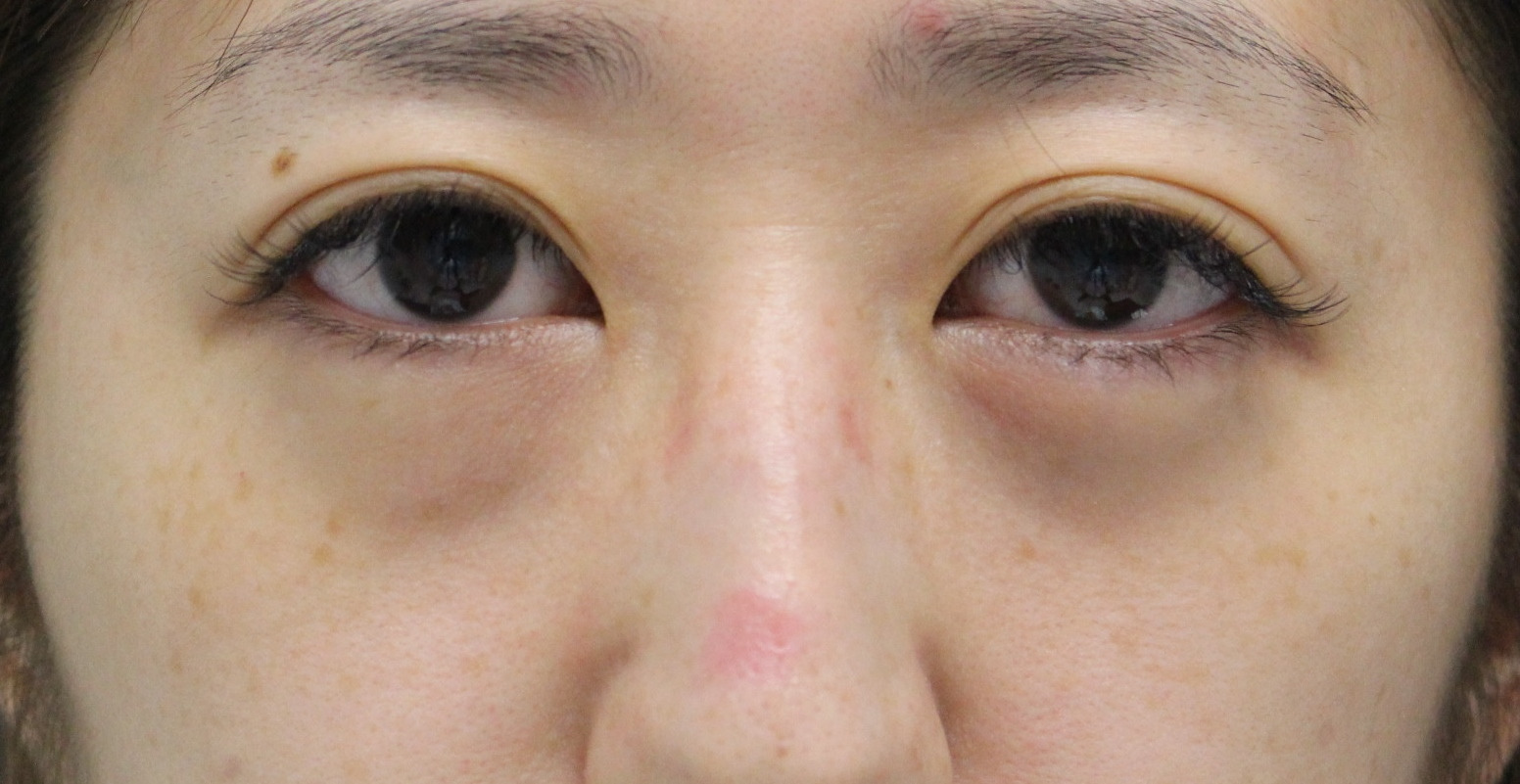 ★210【他院涙袋Hy後】30歳女性　経結膜脱脂術+眼窩脂肪注入